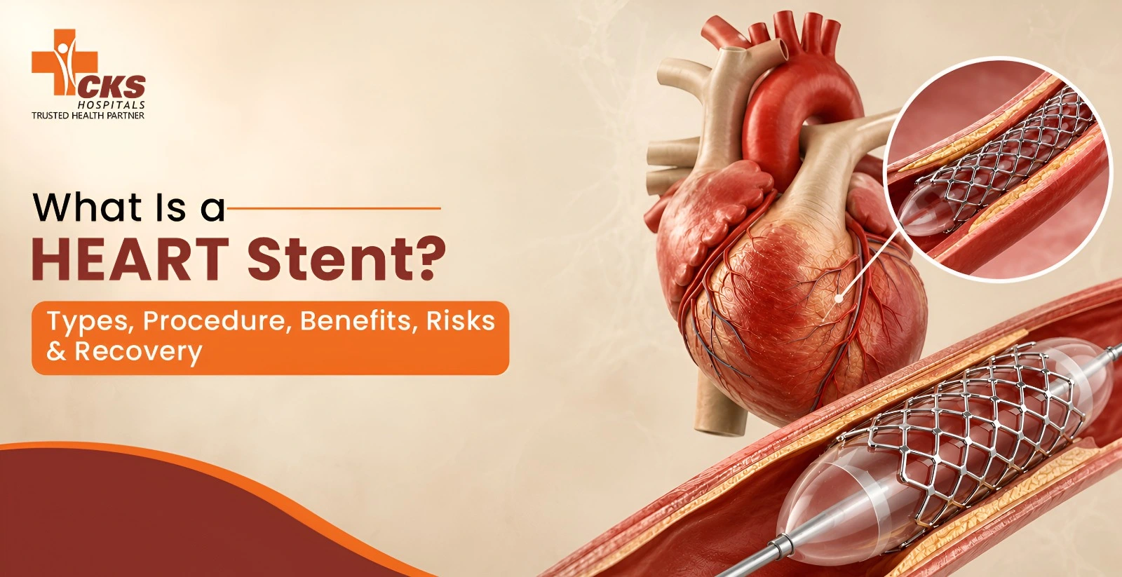 What Is a Heart Stent? Types, Procedure, Benefits, Risks & Recovery